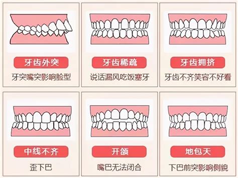 上下排牙齒平行|牙齒咬合重要嗎？原來上下排牙齒咬合沒那麼簡單